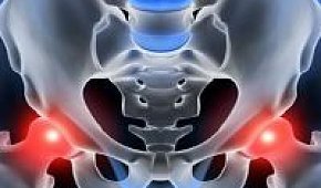 Симптомы и лечение артроза тазобедренного сустава