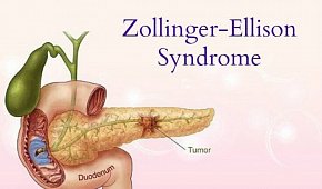 Лечение Золлингера-Эллисона