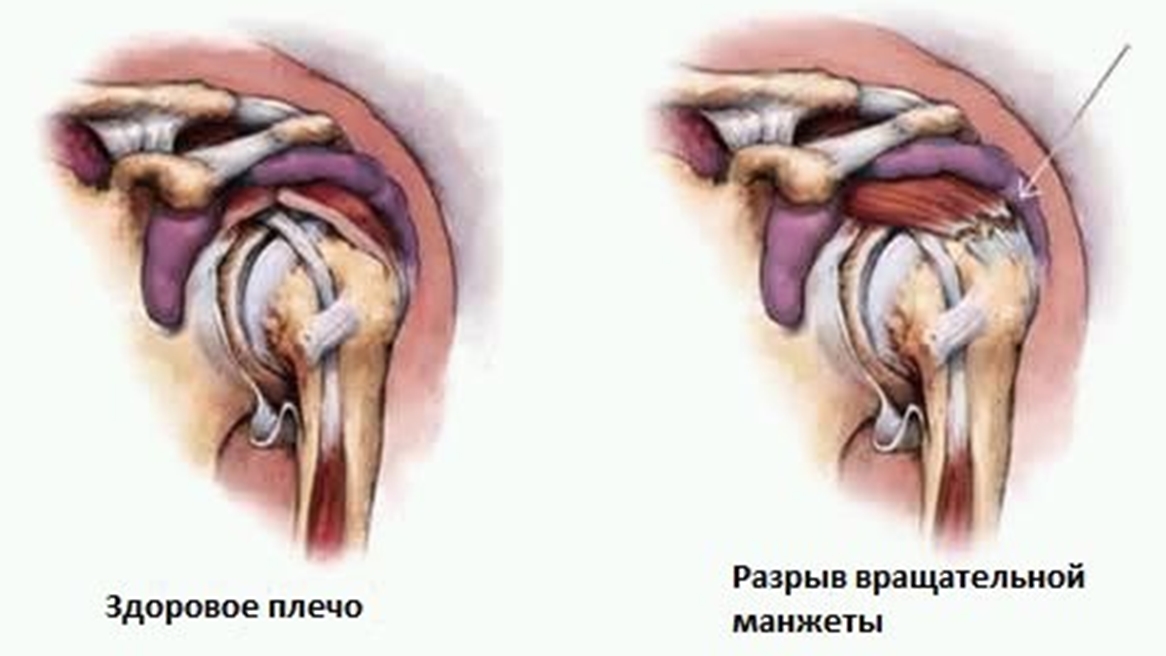 Разрыв надостного сухожилия плечевого сустава лечение. Ротаторная манжета плечевого сустава. Мышцы ротаторной манжеты плечевого сустава. Ротаторная манжета плечевого сустава анатомия. Повреждения плеча вращательной манжеты s46.