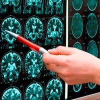 Инсульт ствола головного мозга (стволовой инсульт): причины, симптомы и диагностика. Лечение в Москве по низким ценам