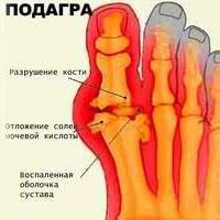 Подагра - причины, симптомы и лечение