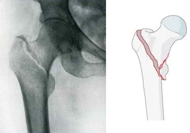 перелом шейки бедренной кости