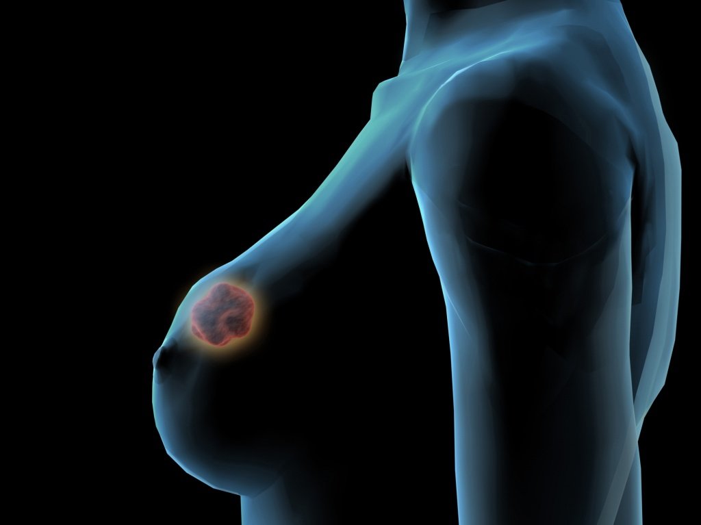 Рак молочной железы, первая стадия - диагноз, прогноз, выживаемость