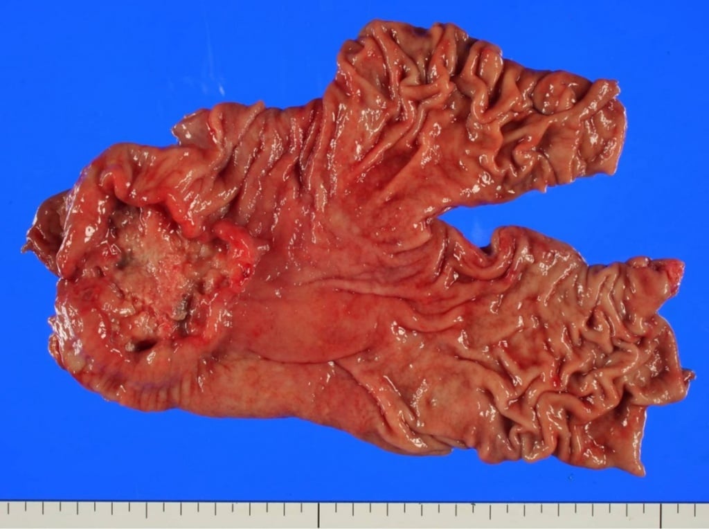 Диффузный тип рака желудка thumbnail