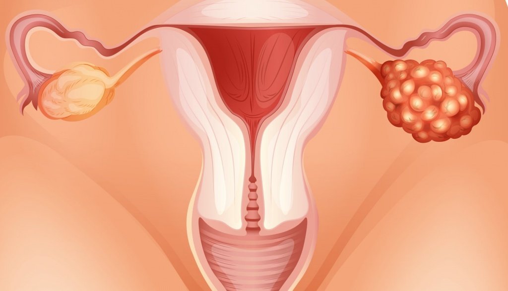 Внутренний эндометриоз матки: причины, формы, лечение