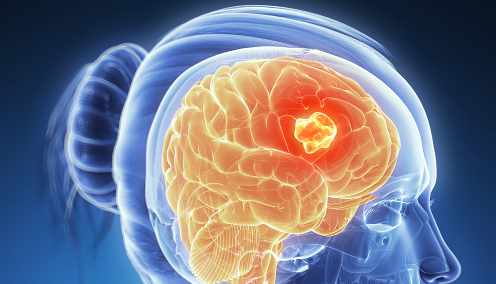 Глиобластома головного мозга - симптомы, признаки, причины