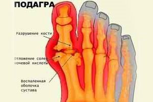 Симптомы подагры на ногах