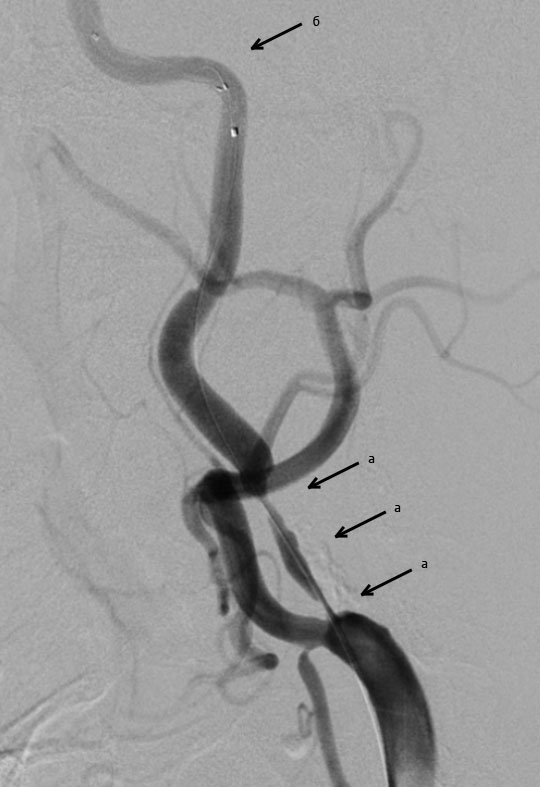  Протяженный стеноз (сужение просвета артерии) 95-99% левой внутренней сонной артерии (а), установленная система защиты от дистальной эмболии (б). 