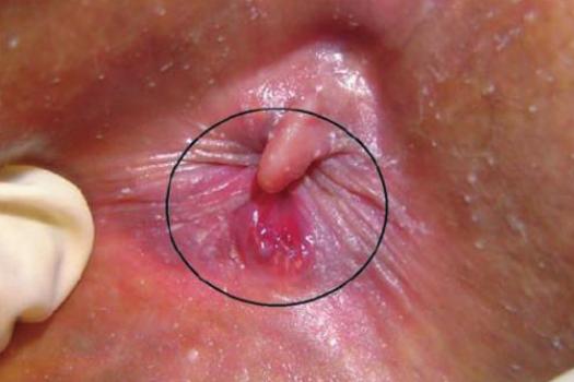 Condilom în simptomele vaginului, Verucile sau condiloamele genitale
