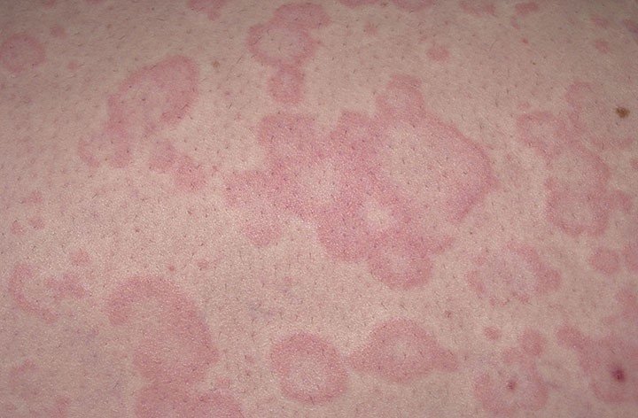 Т-клеточная лимфома кожи
