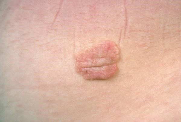 Рак кожи: часто встречающиеся злокачественные опухоли лица