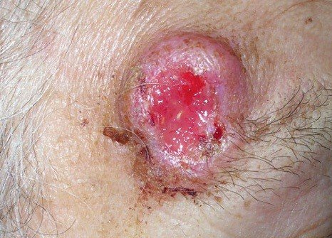 Рак кожи: симптомы, диагностика и лечение