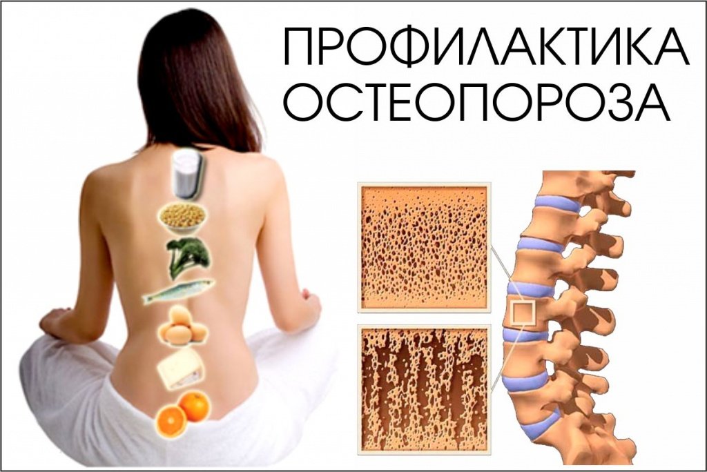 Что принимать для профилактики остеопороза