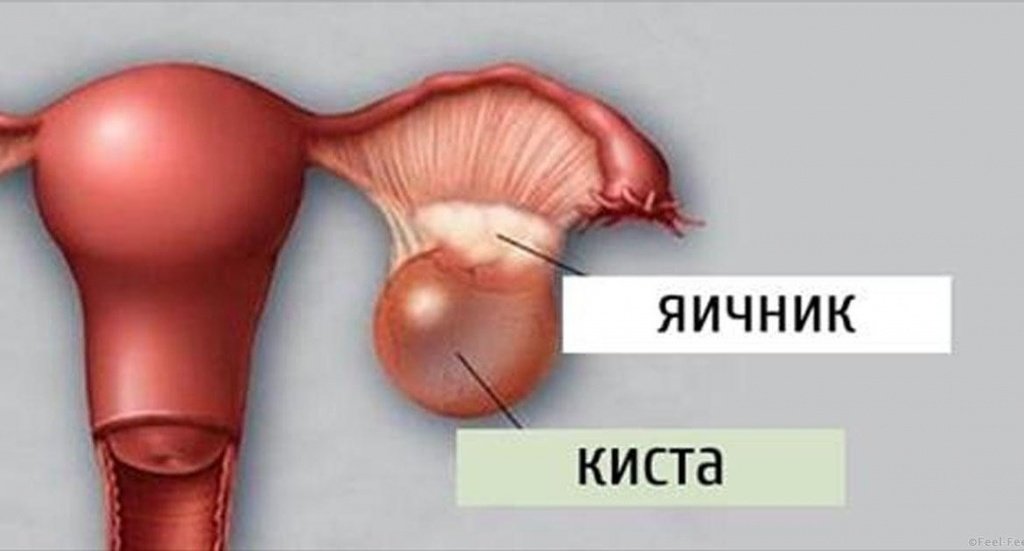 Функциональные кисты яичника: симптомы, диагностика и лечение