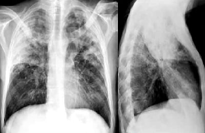 Крупозная пневмония: фото, рентген-диагностика, лечение