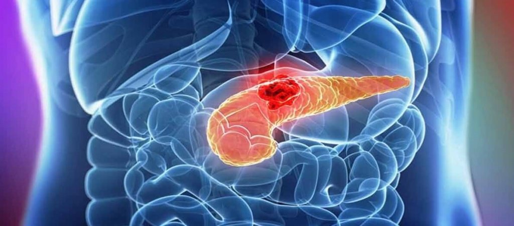 Признаки рака поджелудочной железы у мужчин thumbnail