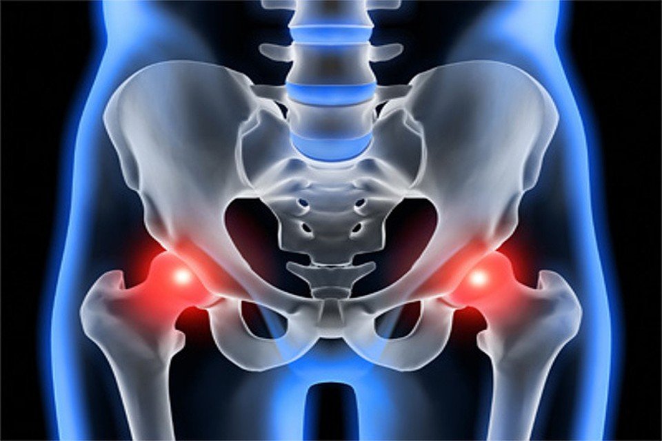 Признаки остеоартроза тазобедренного сустава thumbnail