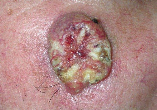 Рак кожи: часто встречающиеся злокачественные опухоли лица