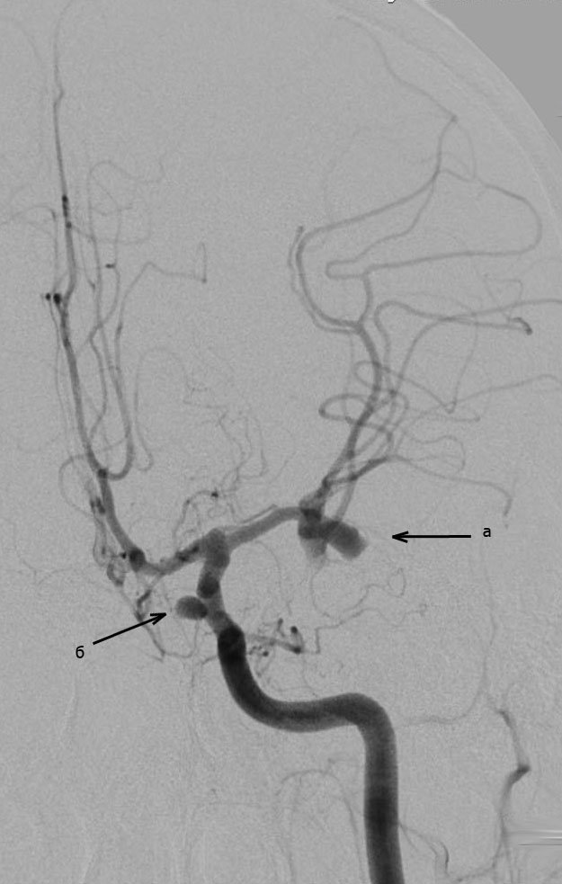  Аневризмы средней мозговой артерии (а), внутренней сонной артерии (б). 