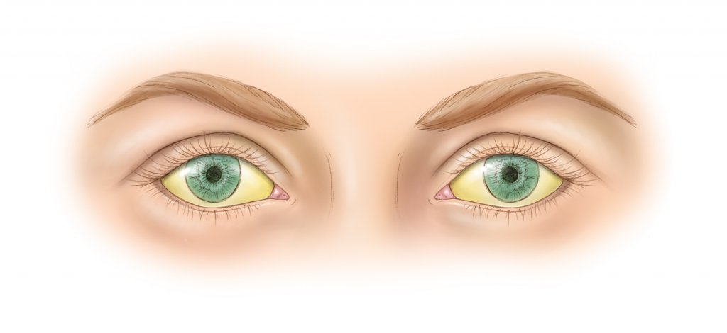 глаза при желтухе