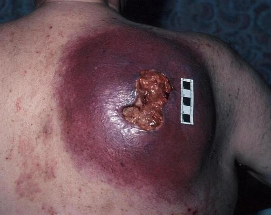 злокачественная меланома кожи неуточненная thumbnail