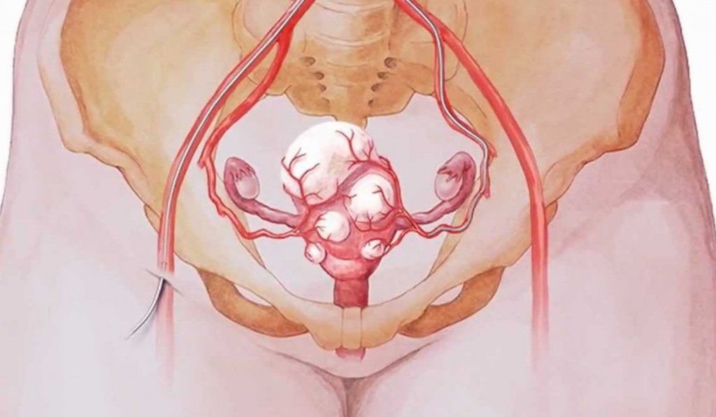 Что такое лейомиома тела матки