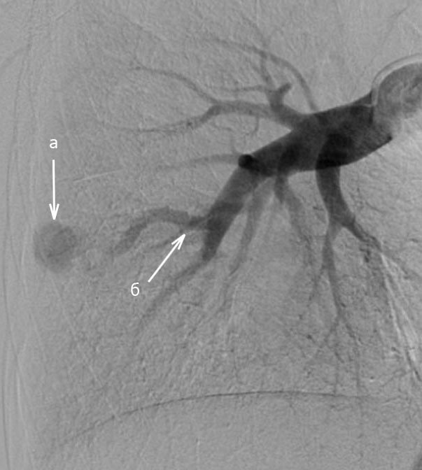  Ангиопульмонография правой легочной артерии. Стелочками указаны афферент (а) венозной фистулы (б) правого легкого. 