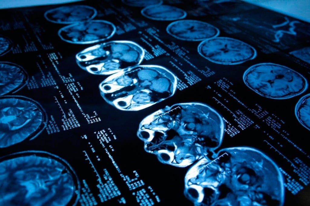 Почему происходит эпилептический припадок: причины и предвестники эпилепсии