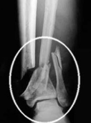 Перелом нижнетрети костей голение со смещением рентген снимок в прямой проекции тяжелая степень С