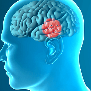 Внутричерепные объёмные процессы (опухоли, субдуральные гематомы и мозговые абсцессы) как причина возникновения деменции