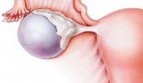 Ретенционные кисты яичника: причины, симптомы в постменопаузе