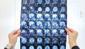 Сотрясение и ушиб мозга