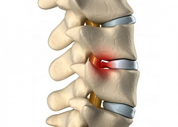 Когда нужна операция при грыже позвоночника?