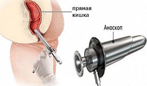 Аноскопия в Москве - подготовка к обследованию и процедуре