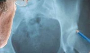 Остеопороз тазобедренного сустава: симптомы и лечение