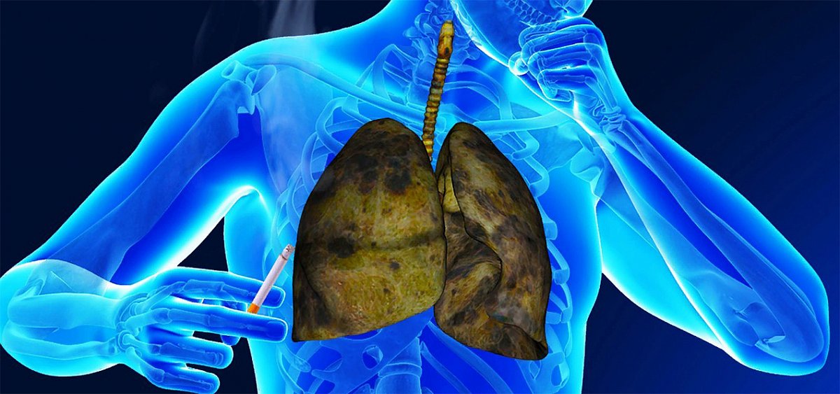Бронхиальная астма или ХОБЛ: как распознать болезни?