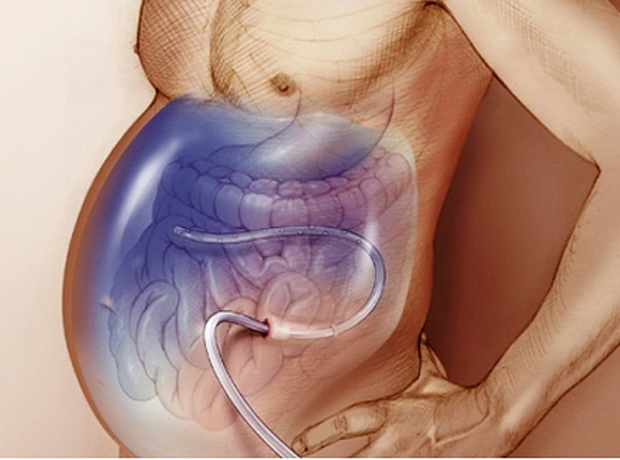 Почему возникает жидкость в брюшной полости: причины и методы лечения
