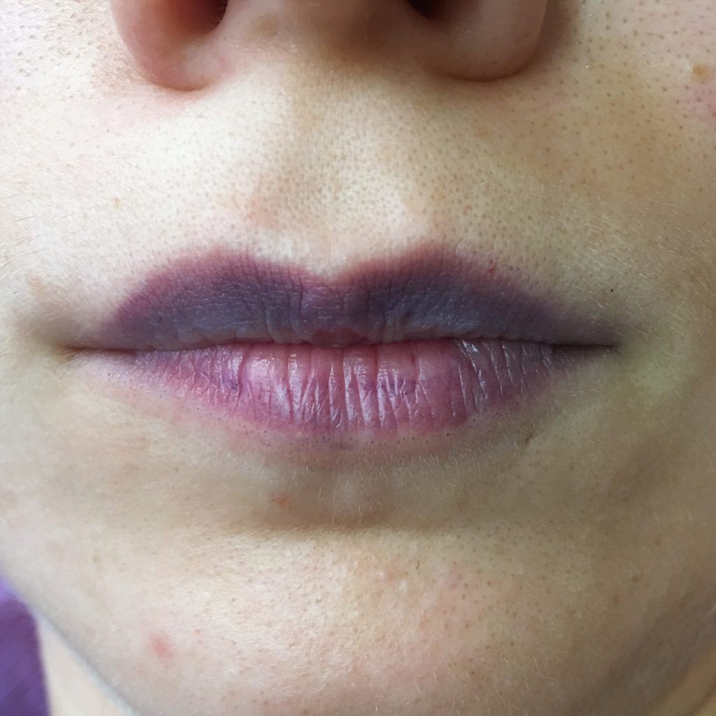 Почему губы меняют цвет: осторожно, это может быть симптомом тяжелых заболеваний