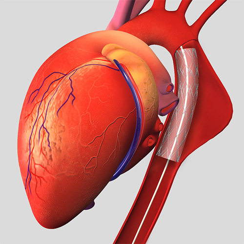 аневризма аорты сердца операция