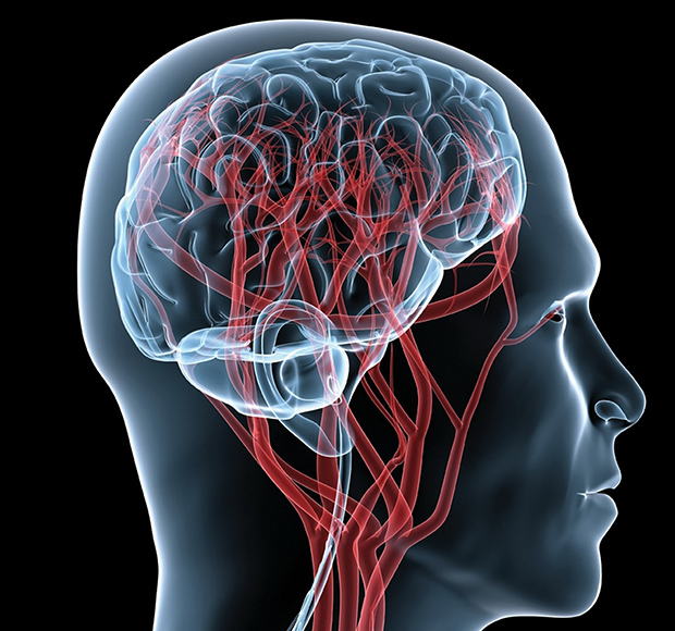 Хроническая ишемия головного мозга (дисциркуляторная энцефалопатия, ДЭП) - симптомы и лечение