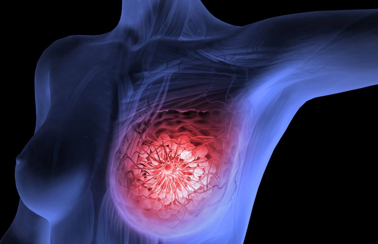Тройной негативный рак молочной железы: что это такое