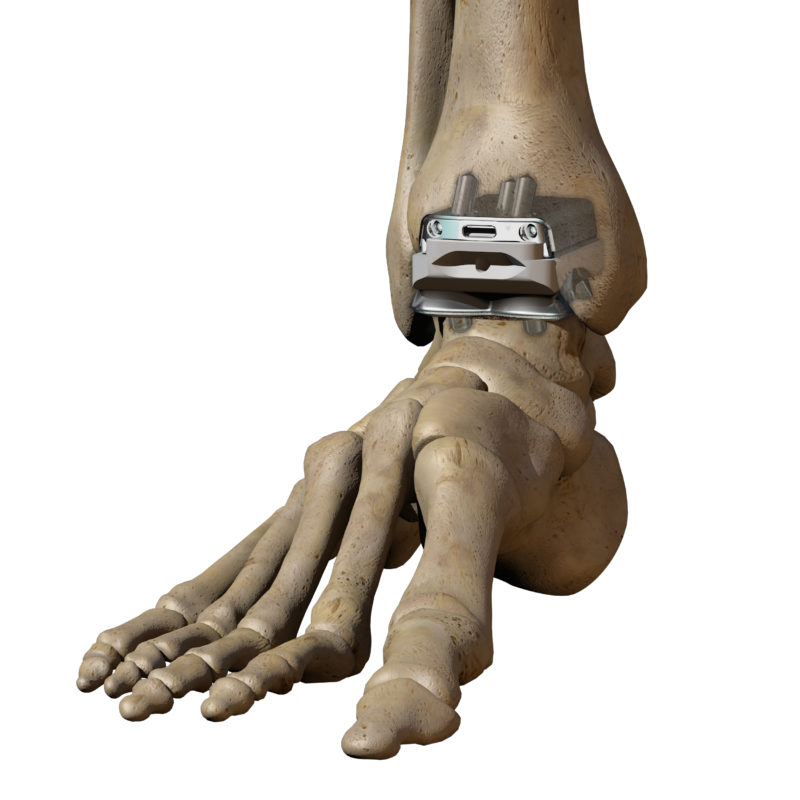 вид протеза