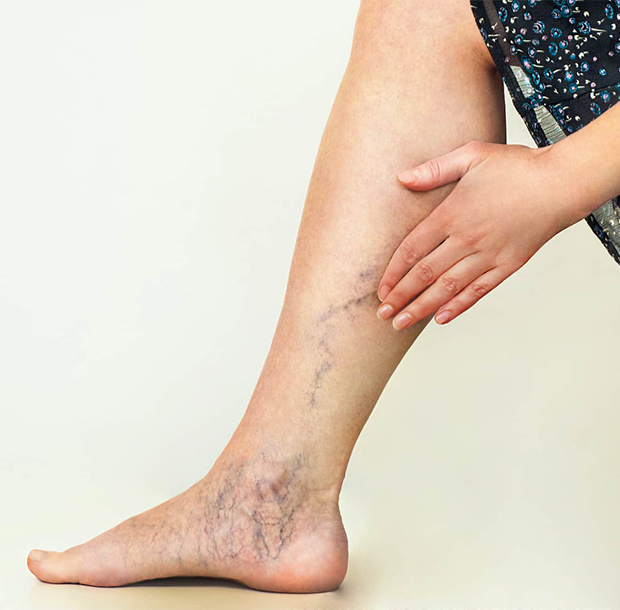 У кого чаще всего болят вены на ногах?